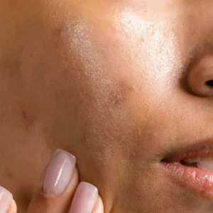 Acne & Breakouts