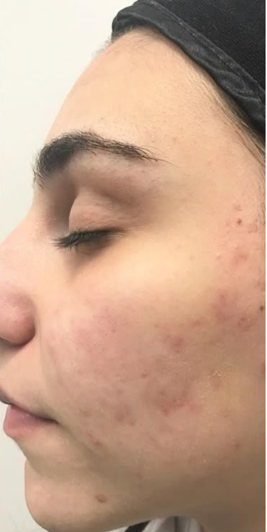 Acne after
