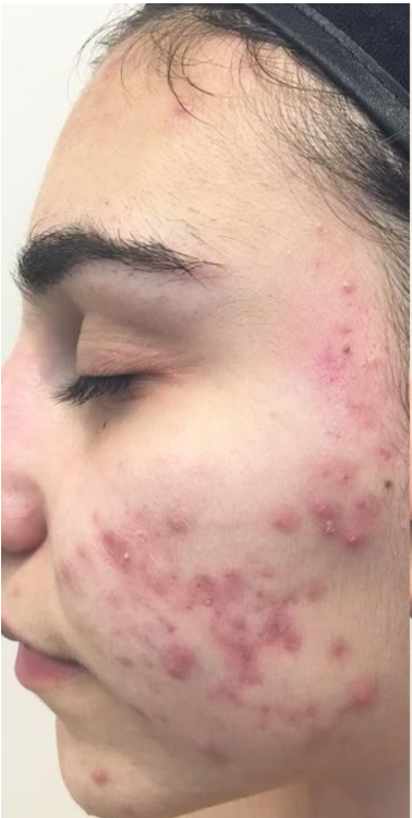 Acne before
