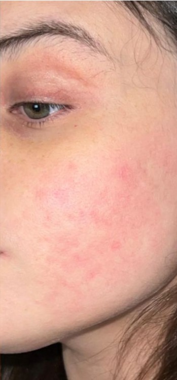 Melasma after