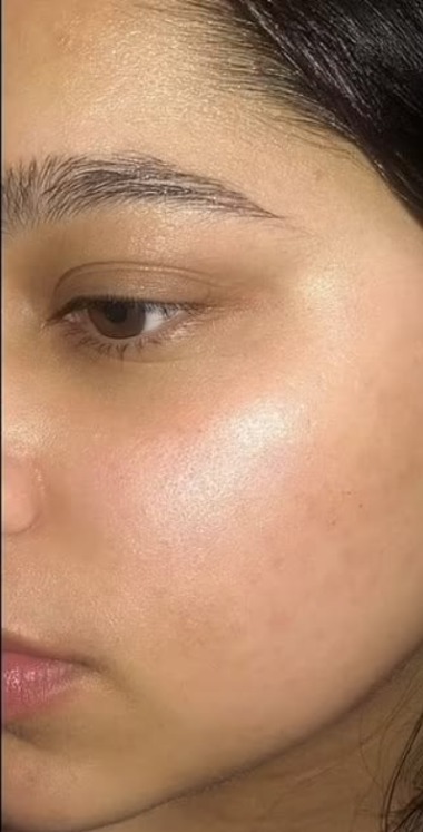 Dark spots after