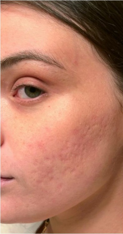 Melasma before